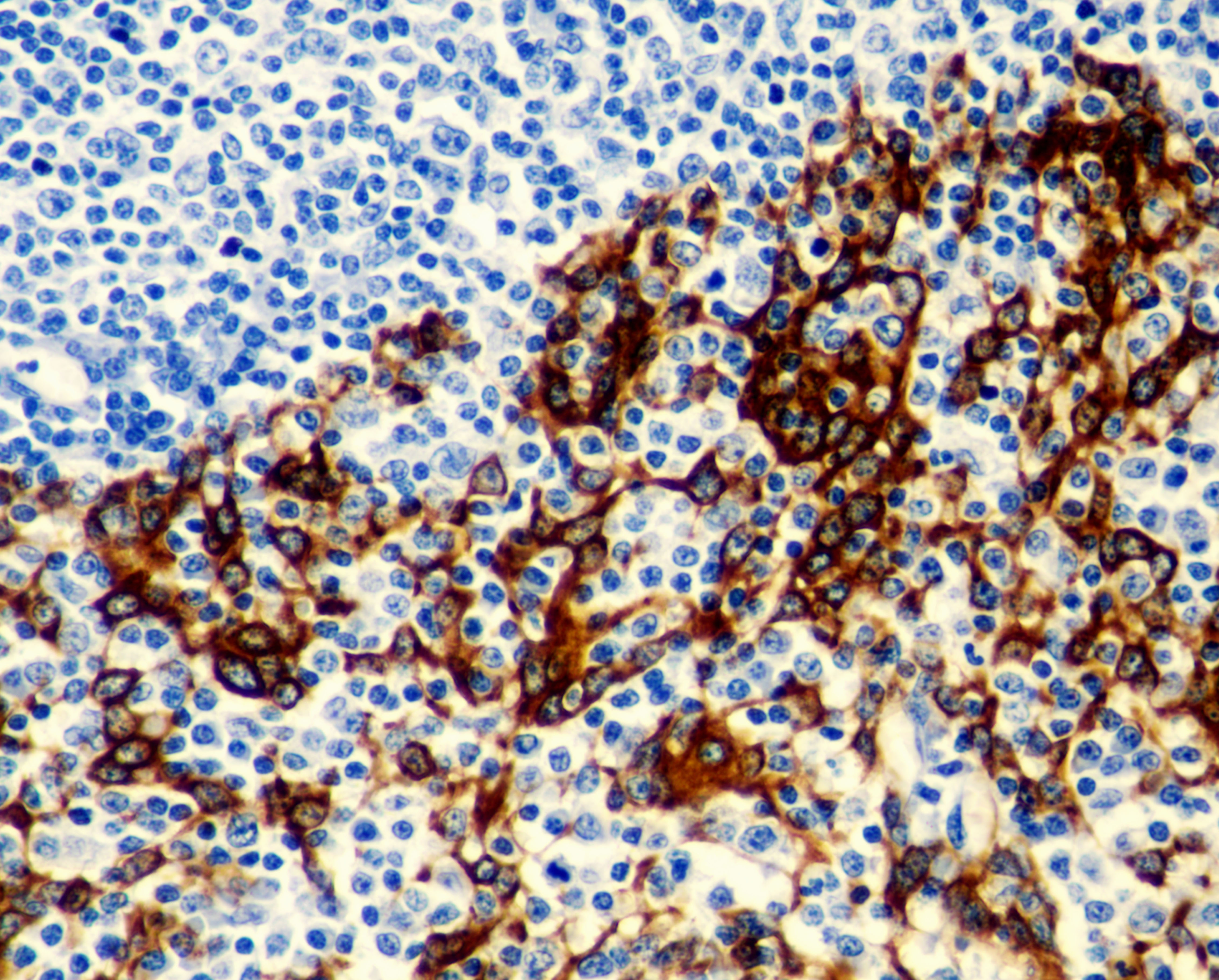 Cytokeratin 5 (CK-5)